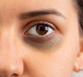 how to get rid of eye Dark Circles