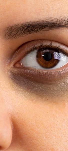 how to get rid of eye Dark Circles