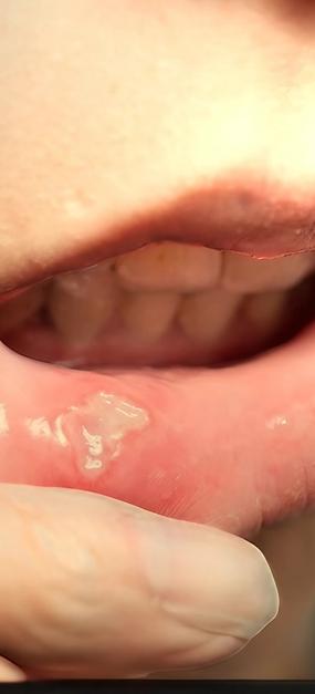 Yoga and Pranayama for mouth ulcers