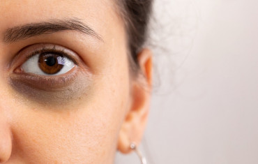 Dark Circles