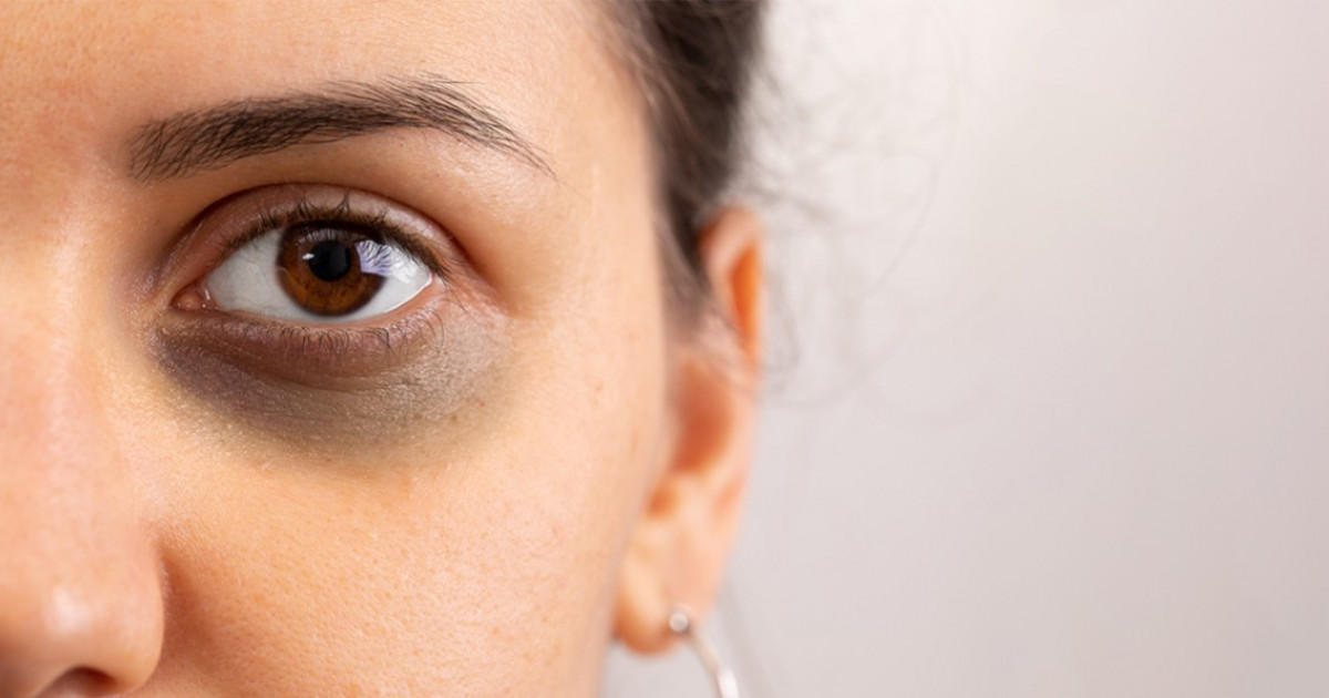 Ayurveda remedies  tips to get rid of dark eye circles | The Art of Living  India